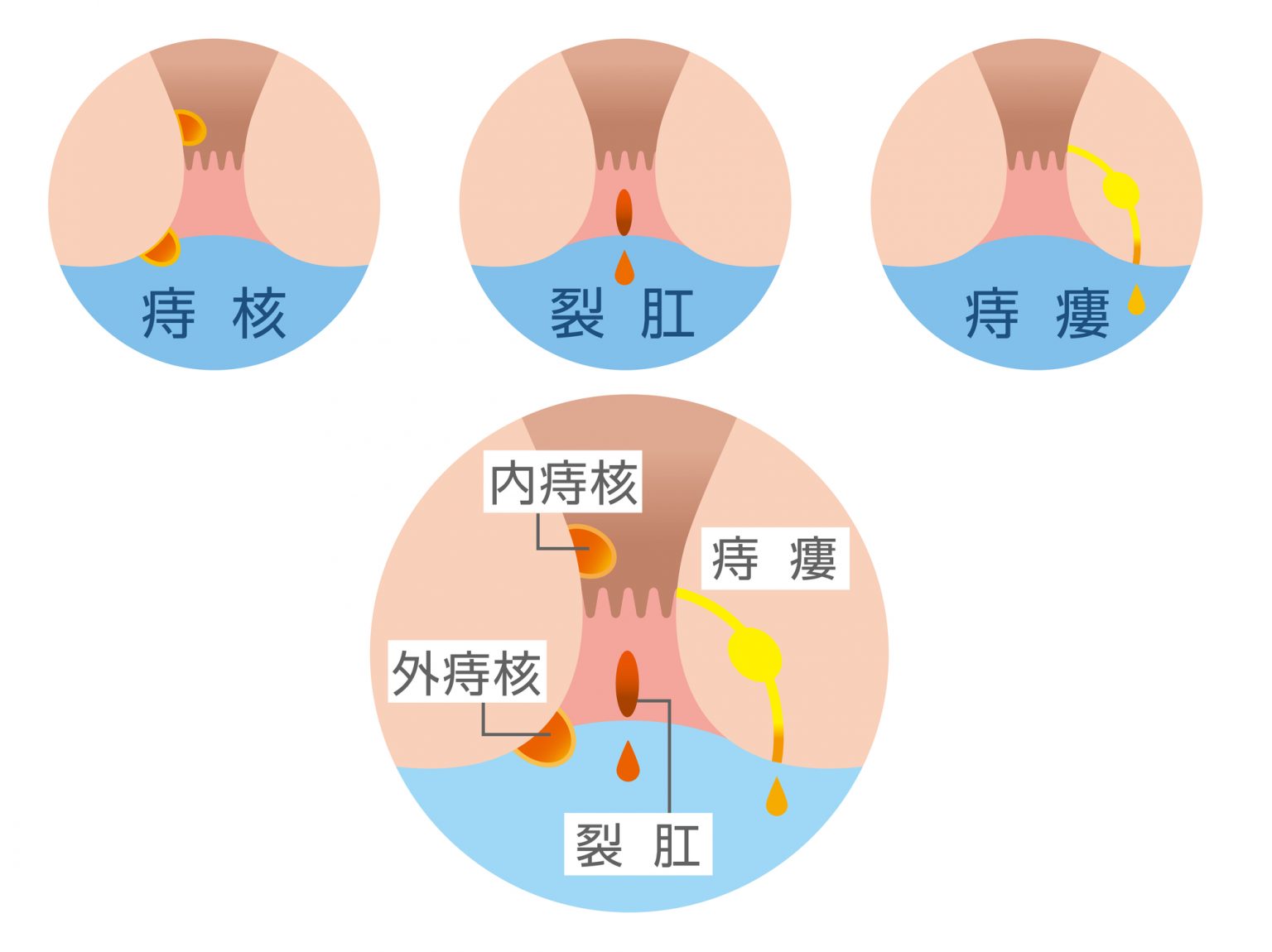 神戸で痔の治療つねみ医院外科専門の痔の治療